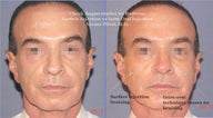 Cheek Augmentation with Radiesse