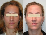 Radiesse for Nasolabial Folds
