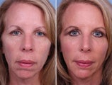 Radiesse, Cheek and Chin Augmentation