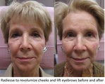 Radiesse facial rejuvenation - Revolumization of Cheeks and Eyebrow Lift