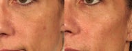 Radiesse Injectable Filler