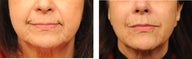 Radiesse to Nasolabial Folds