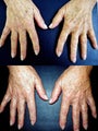 Filler of Doral Hands