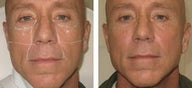 Non-surgical Face Lift with Radiesse