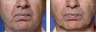 Restylane (Filler)