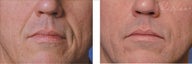Restylane