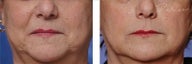 Restylane