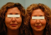Injectable Fillers (Restylane/Perlane)