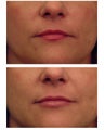 Injectable Filler
