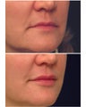 Injectable Filler