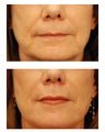 Restylane