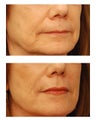 Restylane