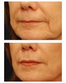 Restylane