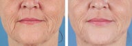 Dermal Filler to Wrinkles