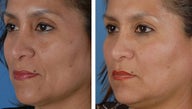 Filler injections to the cheek folds