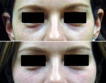 Filling of under-eye hollows / tear troughs with hyaluronic acid filler