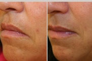 Restylane
