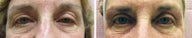 Eye Rejuvenation Restylane