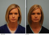 Facial Fillers for cosmetic Enhancement