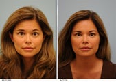 Restylane