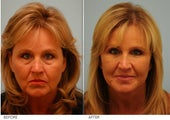 Restylane