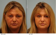 Restylane and Short Term Botox