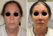 Facial Rejuvenation with Filler