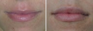 Lip Augmentation