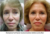 Restylane full facial rejuvenation