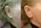 Restylane Ear Rejuvenation