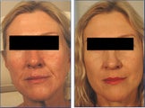 Restylane for Laugh Lines Before and After Photo