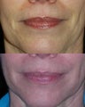 HA filler to lower face