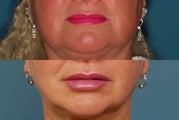 Restylane to Lips