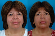 Restylane