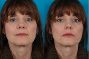 Restylane