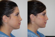 Restylane