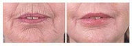 Restylane for smoker lines