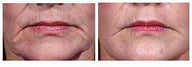 Restylane for wrinkles