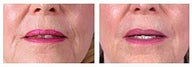 Restylane for wrinkles and marionette lines