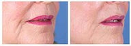 Restylane for nasolabial folds and marionette lines