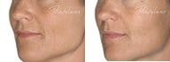 Before and after Restylane on fine lines