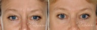 Before and after Restylane on fine lines