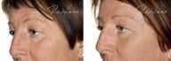 Before and after Restylane on fine lines