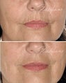 Before and after Restylane on fine lines