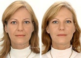Before and after restylane full face
