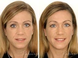 Before and after restylane full face