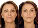 Restylane Full Face Treatment
