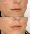 Restylane Lip Definition Before After