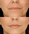 Restylane Lips Wrinkles Before After
