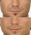 Restylane Male Nasolabial Folds Before After